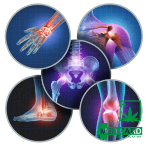 Medical Marijuana Arthritis